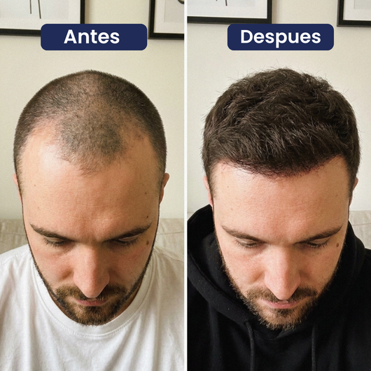 Reverso. Serum para el crecimiento del cabello